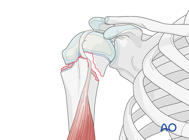 Reduction maneuver of a Salter-Harris type-II fracture of the pediatric proximal humerus