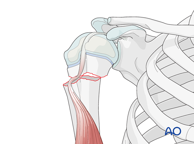 Open reduction of a simple metaphyseal fracture of the pediatric proximal humerus