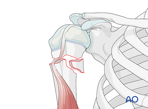 Open reduction of a multifragmentary metaphyseal fracture of the pediatric proximal humerus