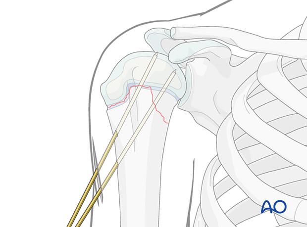 K-wire fixation of a Salter-Harris type-II fracture of the pediatric proximal humerus