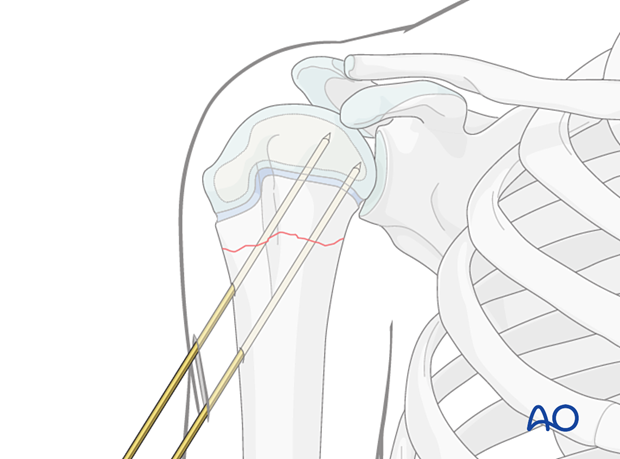 K-wire fixation of a simple metaphyseal fracture of the pediatric proximal humerus