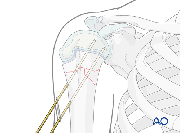 K-wire fixation of a multifragmentary metaphyseal fracture of the pediatric proximal humerus