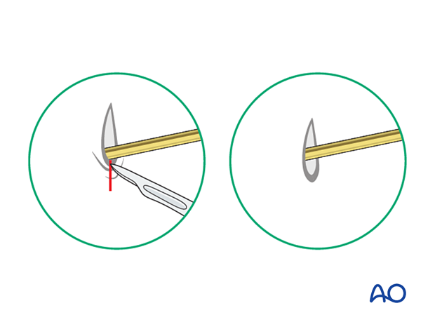 Release of tethered skin around the K-wire by extending the incision