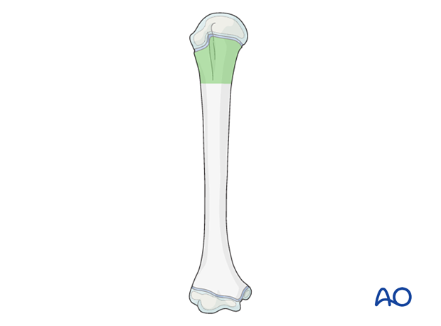 Optimal fracture level for elastic nailing of pediatric proximal humerus