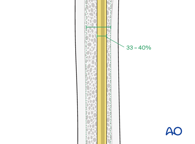 Elastic nail diameter