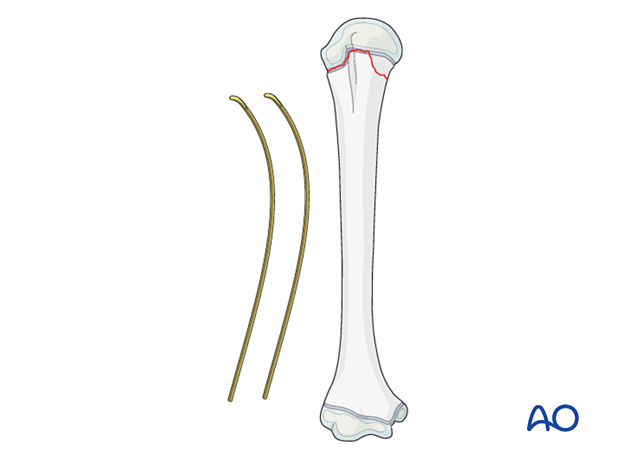 Precontouring the elastic nail for fixation of a Salter-Harris II fracture of the pediatric proximal humerus