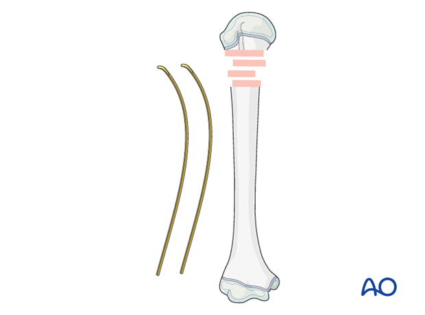 Precontouring the elastic nail for fixation of a metaphyseal fracture of the pediatric proximal humerus