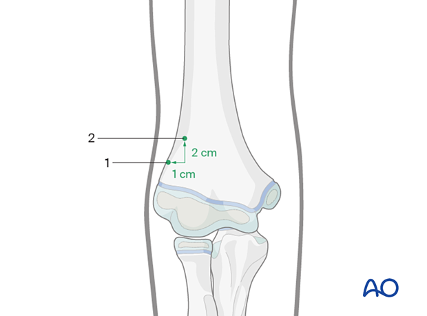 Entry points for retrograde elastic nailing of humeral fractures