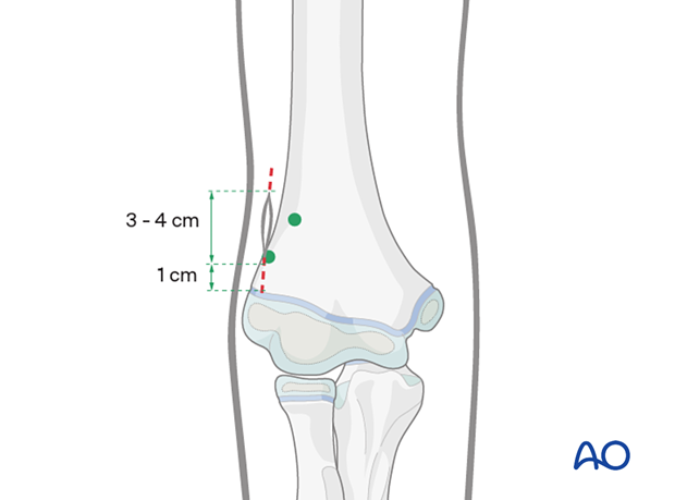 Entry points for retrograde elastic nailing of humeral fractures