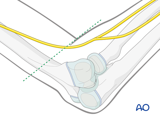 To avoid injury to the radial nerve, the entry points should be below the level of the anterior forearm when the elbow is 90° flexed.