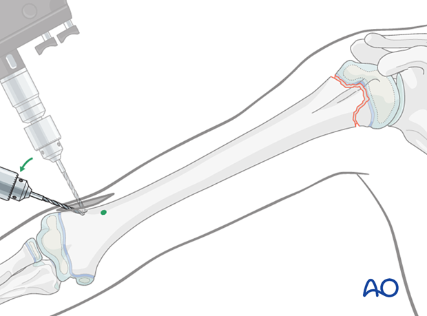 Opening the canal for retrograde elastic nailing of humeral fractures