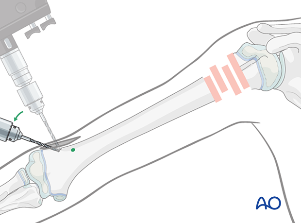 Opening the canal for retrograde elastic nailing of humeral fractures