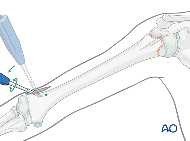 Opening the canal for retrograde elastic nailing of humeral fractures