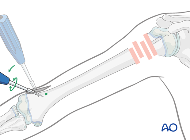 Opening the canal for retrograde elastic nailing of humeral fractures