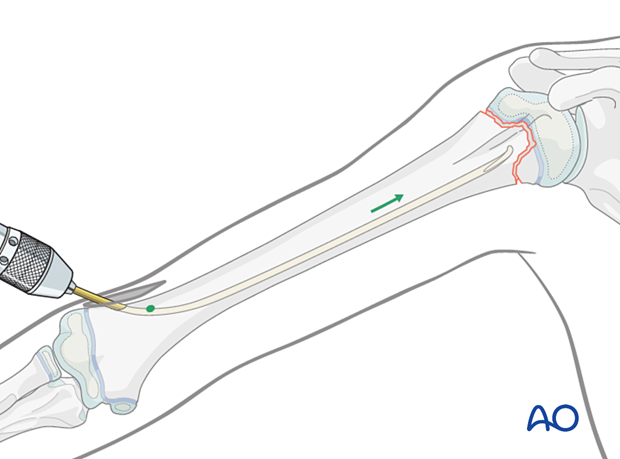 Retrograde nail insertion for elastic nailing of a humeral fracture