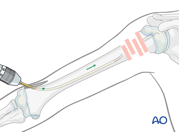 Retrograde nail insertion for elastic nailing of a humeral fracture