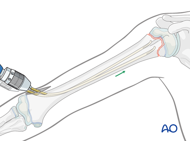 Retrograde nail insertion for elastic nailing of a humeral fracture