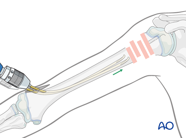 Retrograde nail insertion for elastic nailing of a humeral fracture