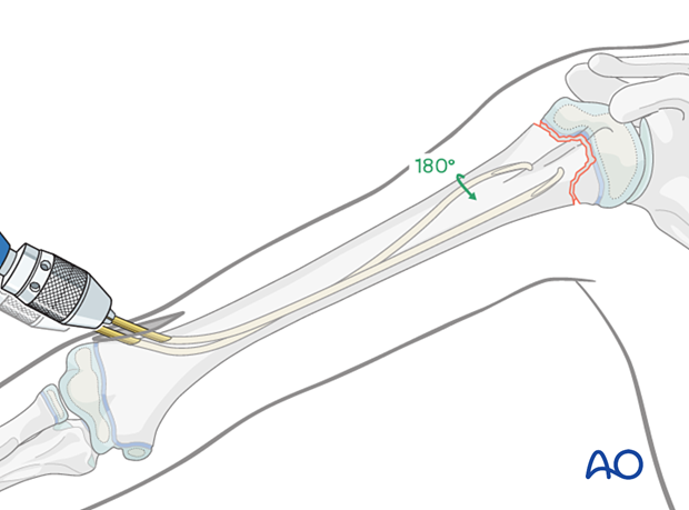 Retrograde nail insertion for elastic nailing of a humeral fracture