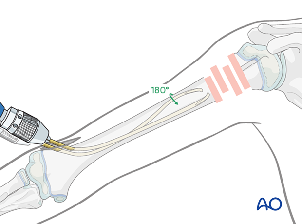 Retrograde nail insertion for elastic nailing of a humeral fracture