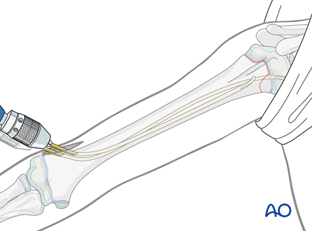 Retrograde nail insertion for elastic nailing of a humeral fracture