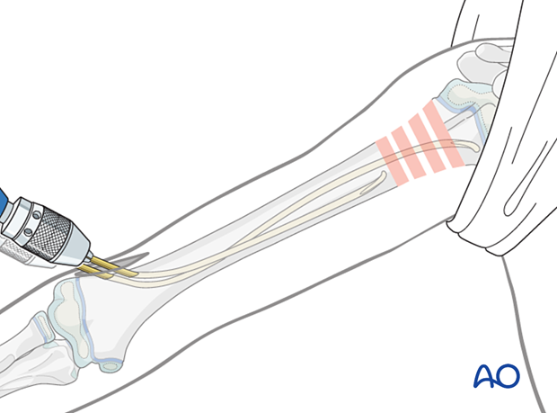 Retrograde nail insertion for elastic nailing of a humeral fracture