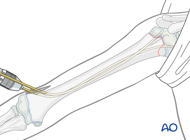 Retrograde nail insertion for elastic nailing of a humeral fracture