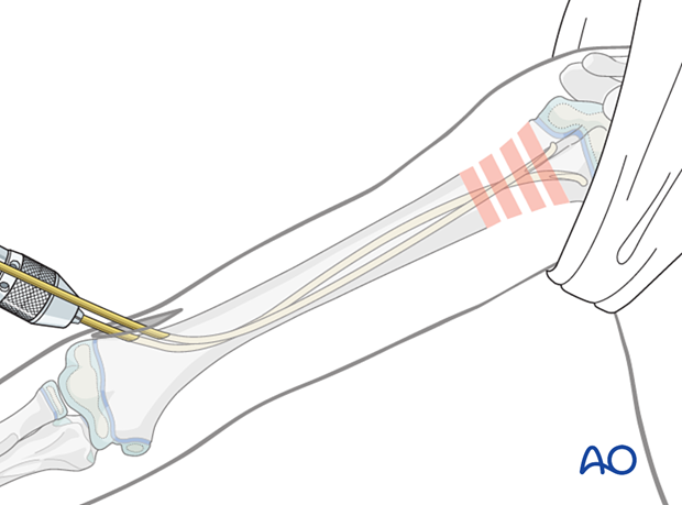 Retrograde nail insertion for elastic nailing of a humeral fracture