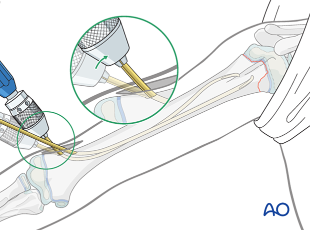 Retrograde nail insertion for elastic nailing of a humeral fracture