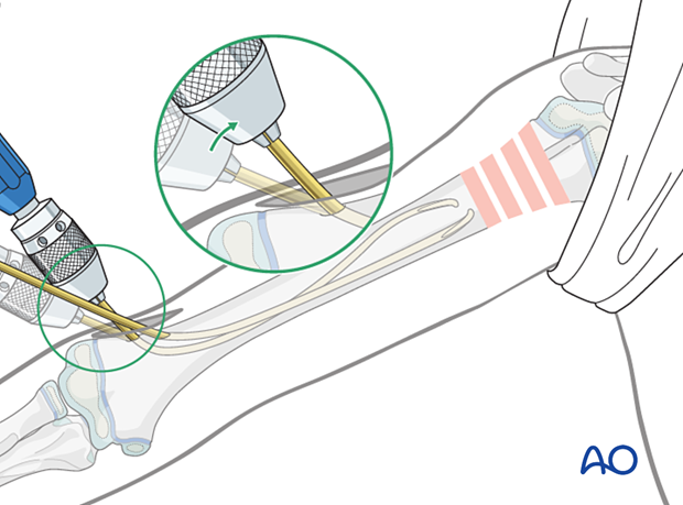 Retrograde nail insertion for elastic nailing of a humeral fracture