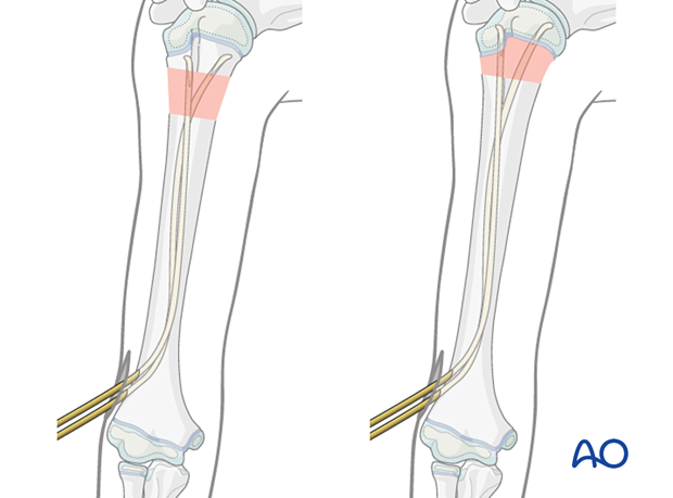 Retrograde nail insertion for elastic nailing of a humeral fracture