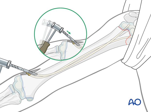 Retrograde nail insertion for elastic nailing of a humeral fracture