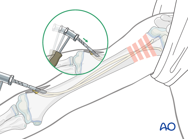 Retrograde nail insertion for elastic nailing of a humeral fracture