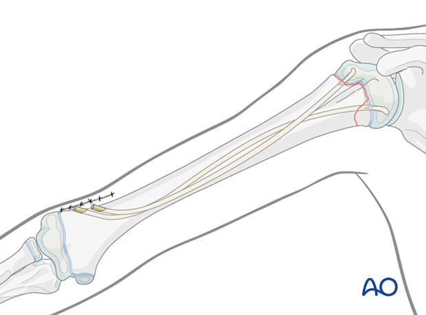 Elastic nailing of a Salter-Harris II fracture of the pediatric proximal humerus