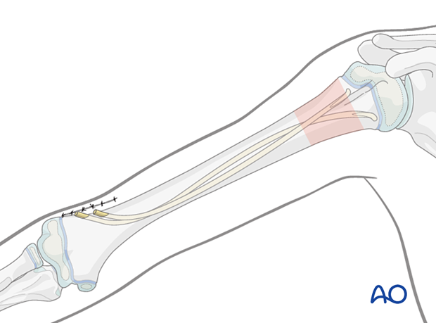 Elastic nailing of a metaphyseal fracture of the pediatric proximal humerus