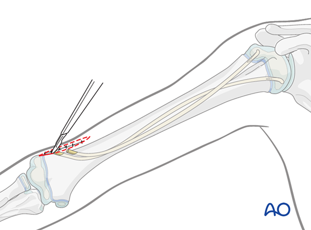 Removal of an elastic nail in the humerus