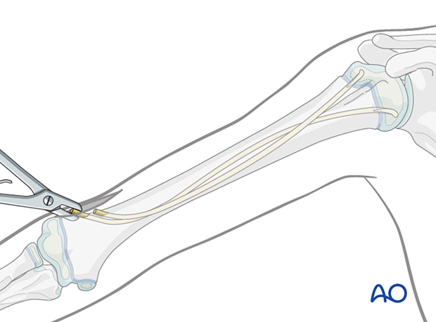 Removal of an elastic nail in the humerus