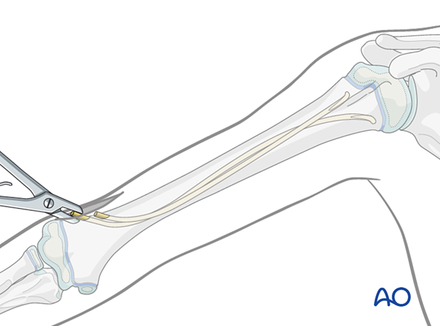 Removal of an elastic nail in the humerus