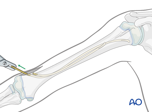 Removal of an elastic nail in the humerus