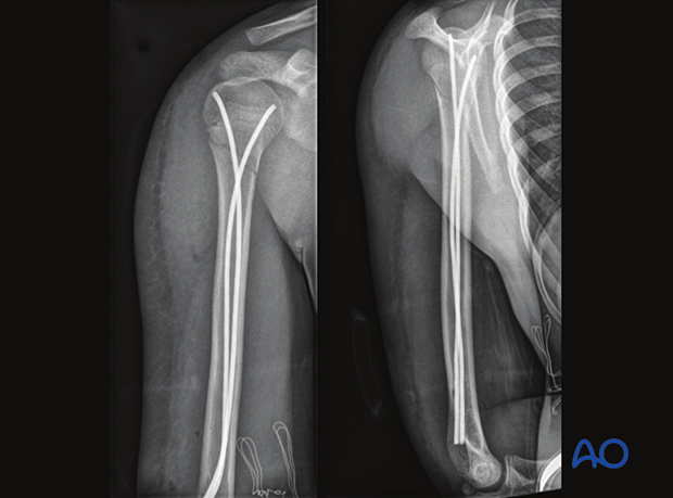 Metaphyseal fracture of the proximal humerus in a 14-year-old male patient stabilized with elastic nailing