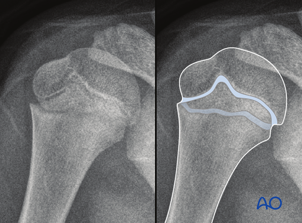 Physis shape and orientation may be mistaken for a fracture in lateral view.