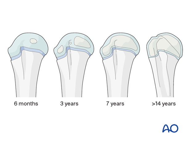 Developmental anatomy of the proximal humerus in the age range of 6 month to >14 years old children