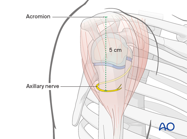 Key anatomical consideration: axillary nerve location, ~5 cm below acromion in children >6 years. Important for younger children due to smaller safe zone for K-wire insertion. Deltoid insertion is a reliable landmark.