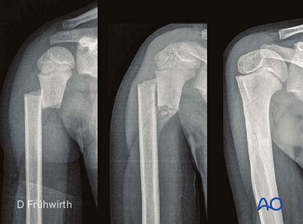Case of a proximal shaft fracture in a 4-year-old patient, x-rays at injury and 12 months post-injury showing complete remodeling of the translation with nonoperative treatment