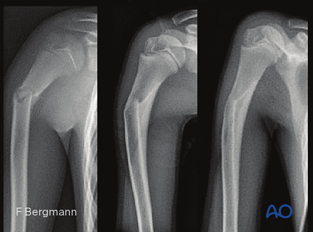 Case of a proximal shaft fracture in a 10-year-old patient, x-rays at injury and 6 months post-injury showing remodeling with nonoperative treatment with subtle residual varus angulation