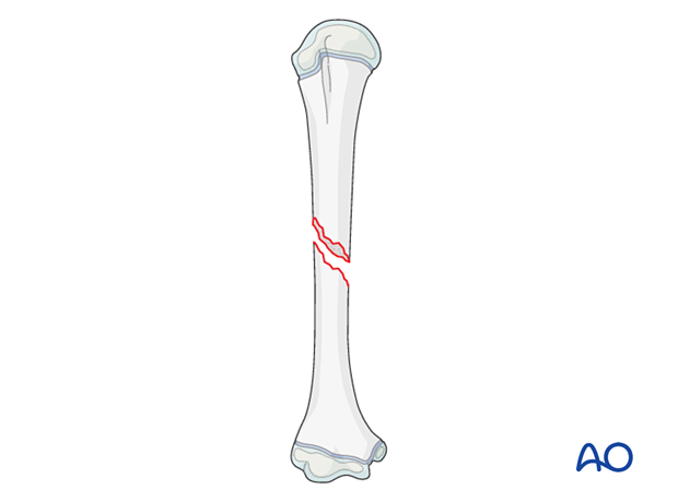 Simple complete oblique shaft fracture of the pediatric humerus