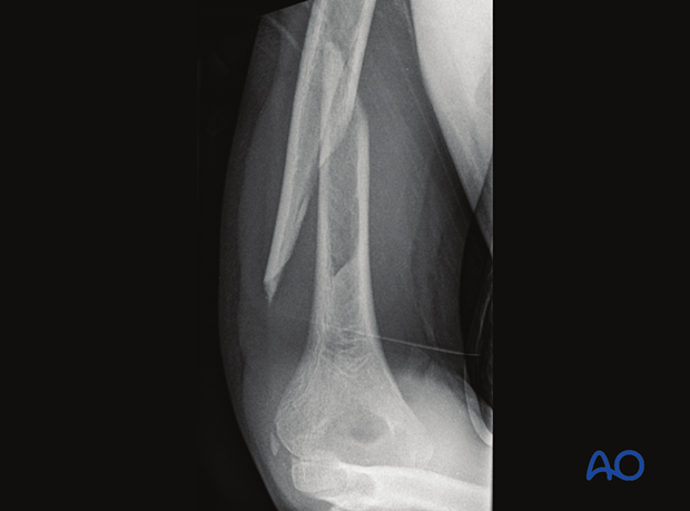 X-ray showing a simple complete oblique shaft fracture of the pediatric humerus