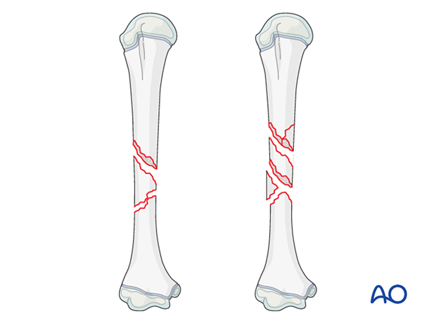 Multifragmentary shaft fracture of the pediatric humerus