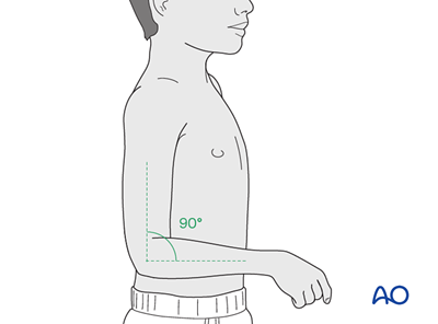 Clamshell Cast Immobilization with splint, brace, or cast for Simple complete oblique ...