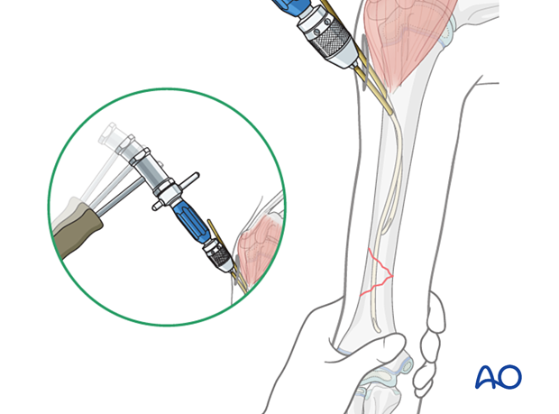 Advance first nail past fracture with gentle hammer blows. Repeat with second nail. Use end caps if needed.